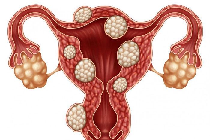 Fibroids Aur Iske Lakshan Kya Hain?