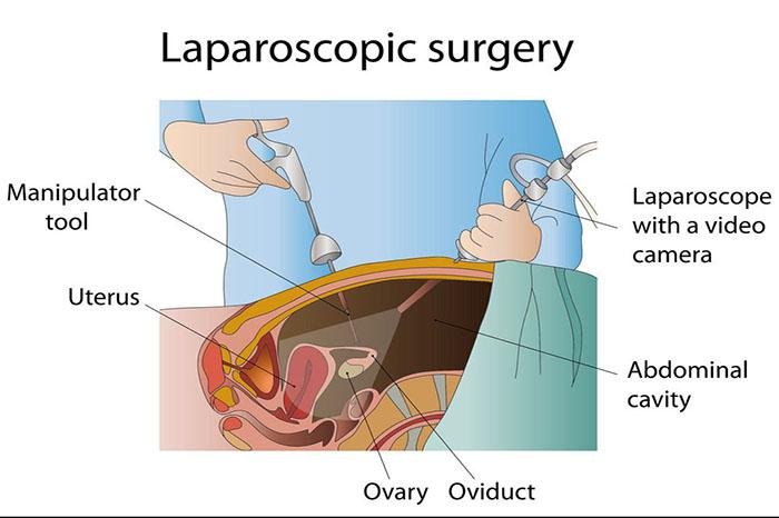 All You Need To Know About Laparoscopic Gynecological Surgeries