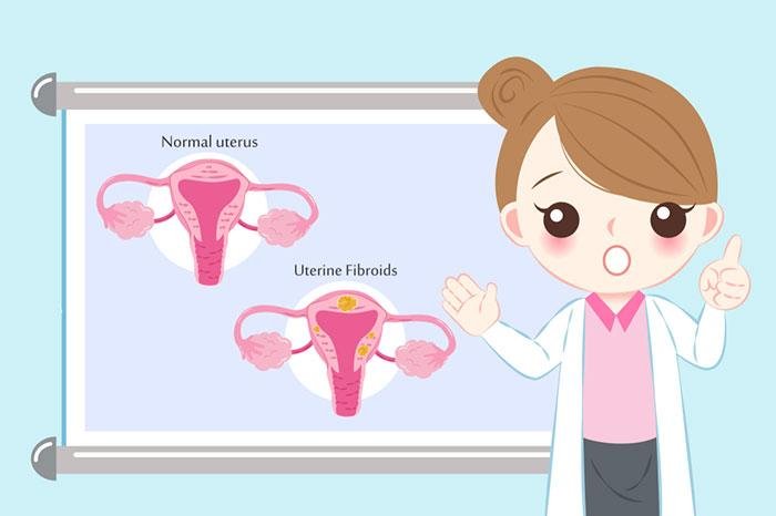 Fibroids: Symptoms, Causes & Treatment