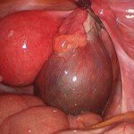Gynecological Open Surgeries in Indore