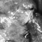 Hysteroscopy Surgery in Indore