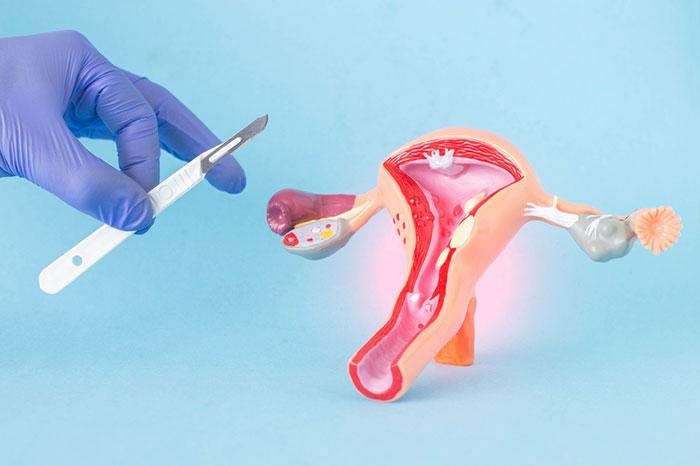 Best Fibroid Removal Surgeon in Indore