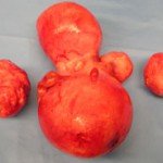 Gynecological Open Surgeries in Indore
