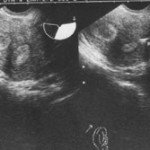 Hysteroscopy Surgery in Indore