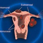 Hysteroscopy Surgery in Indore