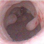 Hysteroscopy Surgery in Indore