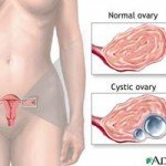 Gynecological Open Surgeries in Indore