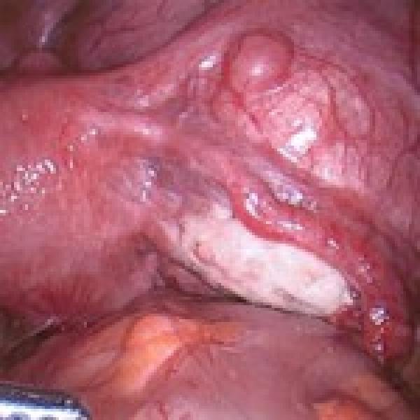 Best Laparoscopic Surgeon in Indore