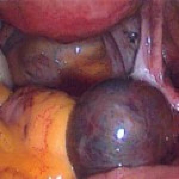 Best Laparoscopic Surgeon in Indore
