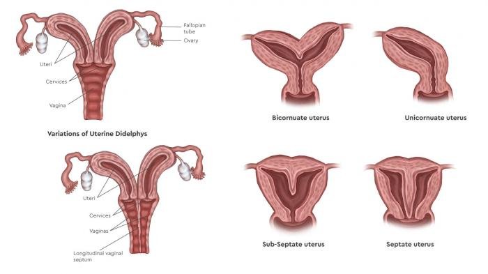 Mullerian Agenesis Treatment in Indore