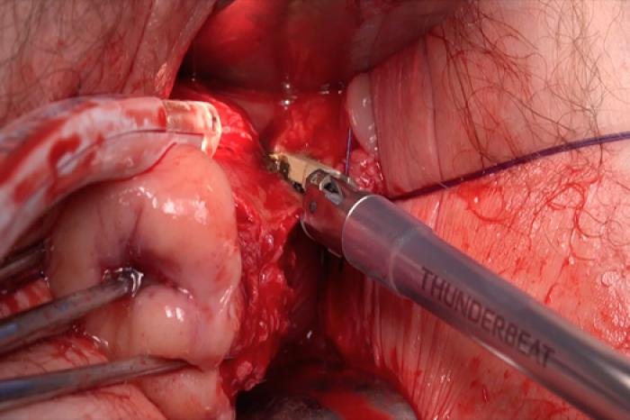 Vaginal Hysterectomy Surgery in Indore